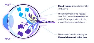 wet AMD within the eye (graphic)