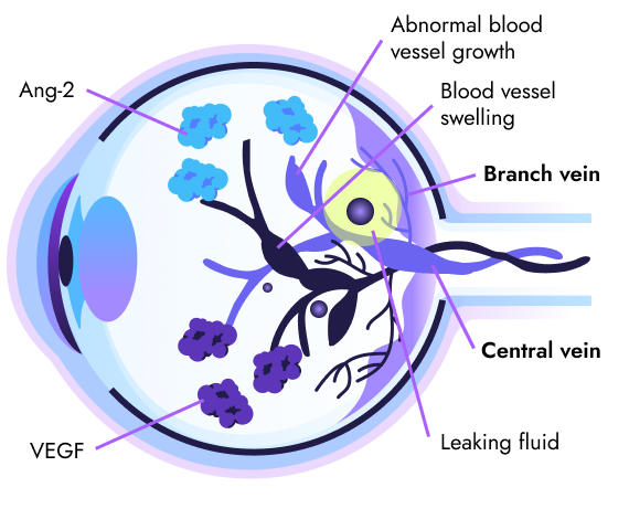 What is RVO? | VABYSMO® (faricimab-svoa)