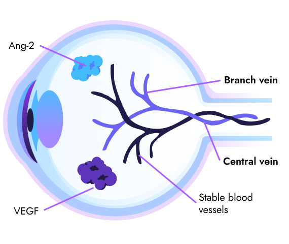 What is RVO? | VABYSMO® (faricimab-svoa)