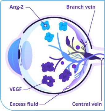 Eyeball graphic depicting leakage and swelling