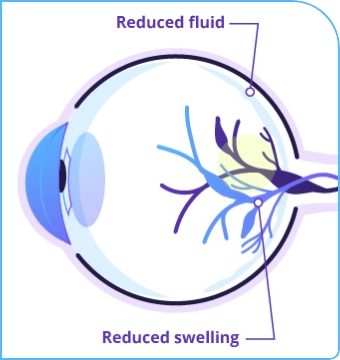 Eyeball graphic depicting reduction of fluid and swelling